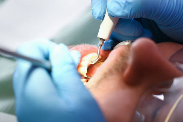 Best Teeth Whitening  in Newton, IL